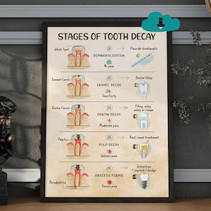 May include: A framed poster illustrating the stages of tooth decay, from white spots to abscess formation. The poster includes diagrams of teeth and associated treatments, such as fluoride and root canals. The text includes "Stages of Tooth Decay".