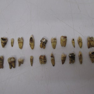 Lot 20 Assorted Human Tooth Teeth Extracted Vintage Dental Research Oddity Dentist #J16