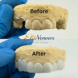 May include: A before-and-after comparison of dental veneers. The top shows a model with natural teeth, labeled "Before." The bottom shows the same model with white veneers, labeled "After." The logo "Elite Veneers Custom Veneers" is also visible.