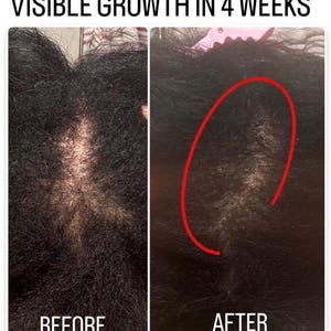 Pode incluir: Uma compara&ccedil;&atilde;o lado a lado do crescimento capilar com o texto VISIBLE GROWTH IN 4 WEEKS. O painel esquerdo mostra uma vista antes de uma risca com cabelo ralo. O painel direito mostra uma vista depois com um c&iacute;rculo vermelho marcado.