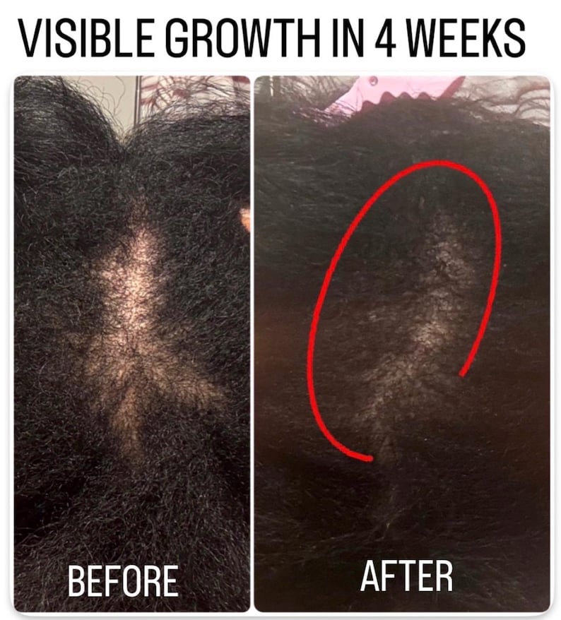 Pode incluir: Uma compara&ccedil;&atilde;o lado a lado do crescimento capilar com o texto VISIBLE GROWTH IN 4 WEEKS. O painel esquerdo mostra uma vista antes de uma risca com cabelo ralo. O painel direito mostra uma vista depois com um c&iacute;rculo vermelho marcado.