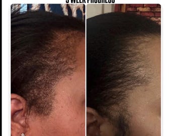 Hair Growth Oil for Thinning Hair | Fast Results 4-6 Weeks | Herbal Infused Scalp Treatment | Dry Scalp, Breakage, Hair Loss Support