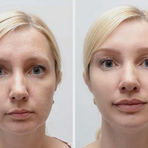 May include: A side-by-side comparison of a woman's face before and after a cosmetic procedure. The woman has blonde hair and blue eyes. The image on the left shows visible wrinkles and uneven skin tone, while the image on the right shows smoother skin.