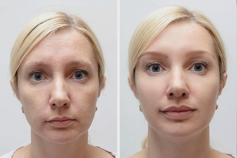 May include: A side-by-side comparison of a woman's face before and after a cosmetic procedure. The woman has blonde hair and blue eyes. The image on the left shows visible wrinkles and uneven skin tone, while the image on the right shows smoother skin.