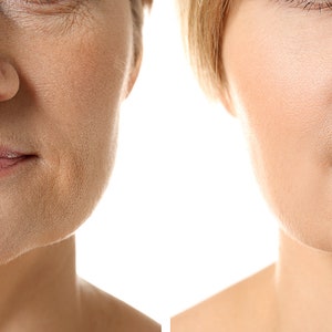 May include: Before and after photos showing the effects of a cosmetic procedure on a person's face. The left side shows wrinkles and sagging skin around the mouth and jawline. The right side shows smoother skin with less visible wrinkles.