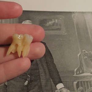 Tooth oddity-Connected molars with weird rooth