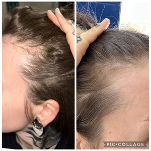 May include: A split image shows a side view of a person's head with dark brown hair. The left side shows thinning hair, while the right side shows improved hair growth. The image is a before-and-after comparison.