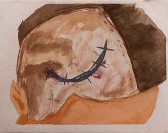 Watercolor Painting on Paper Pseudotumor Cerebri