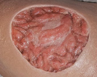 Prótesis para úlcera