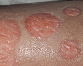 Hauterkrankungen (Psoriasis / Furunkel / Herpes / Warze / Gürtelrose)