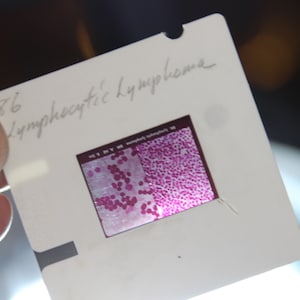 Pode incluir: Um slide com uma imagem microscópica de células, provavelmente para estudo médico ou científico. O slide está rotulado com o texto manuscrito "86 Lymphocytic Lymphoma". A imagem mostra um campo de células rosa e roxas.