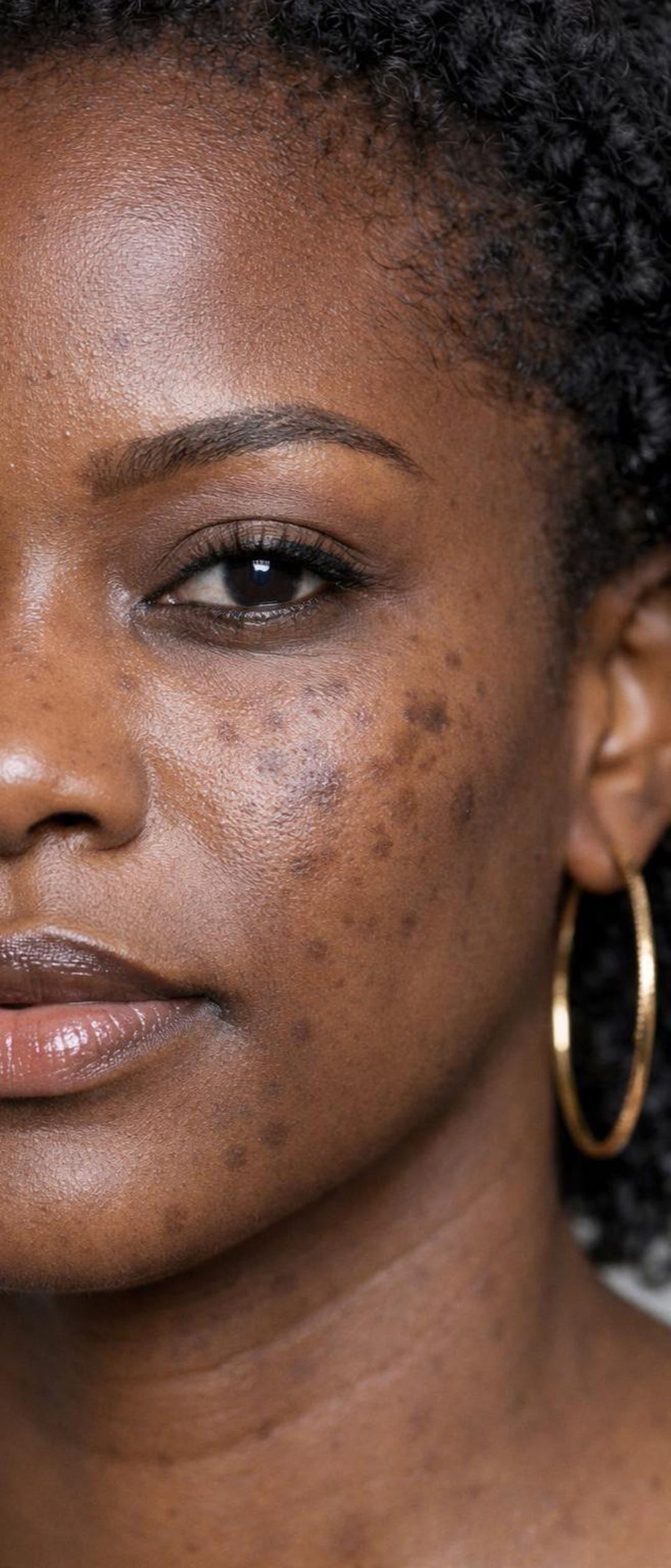 Fade Dark Spots: the Ultimate Guide for Hyperpigmentation in Dark Skin ...