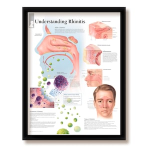 Comprender la rinitis Póster educativo médico enmarcado Diagrama informativo Médicos Oficina Escuela Aula 22x28 pulgadas
