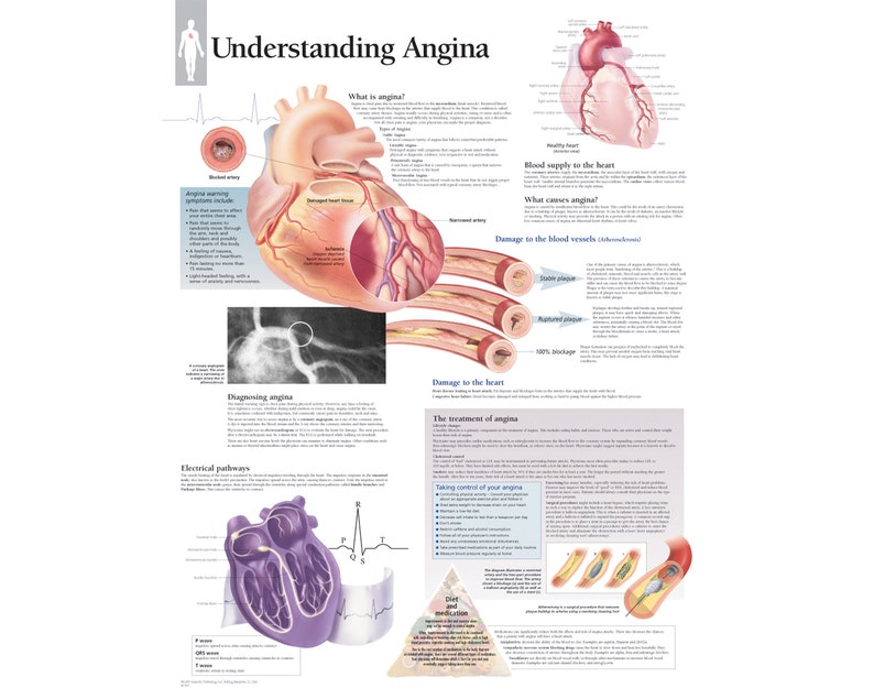 Understanding Angina Framed Medical Educational Informational Poster ...