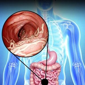 May include: Anatomical illustration of the human digestive system, with a magnified view of the intestinal lining showing parasites. The word "PAR&Aacute;SITOS" is displayed in white text at the top of the image. The image is set against a blue background.