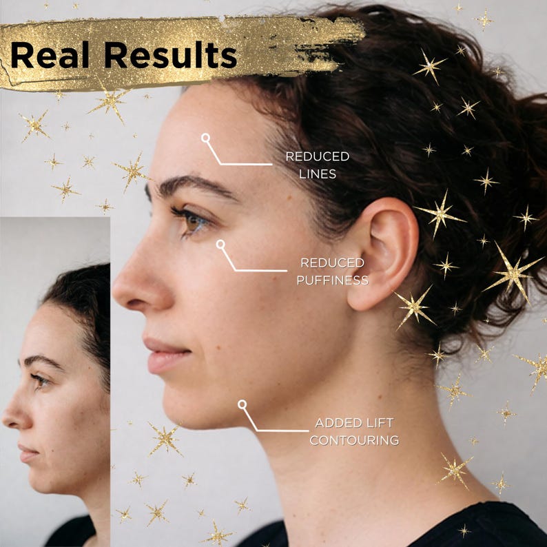 Pode incluir: Uma imagem comparativa do rosto de uma mulher, destacando os resultados antes e depois. A imagem mostra linhas reduzidas, incha&ccedil;o reduzido e contorno facial adicionado. O texto na parte superior diz "Real Results".