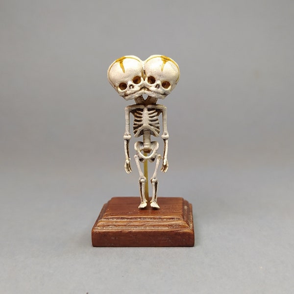 Squelette d'adolescents siamois. Reproduction d'échantillons anatomiques de Dicephalus parapagus dipus. Miniature d'étude médicale pour maisons de poupées à l'échelle 1:12