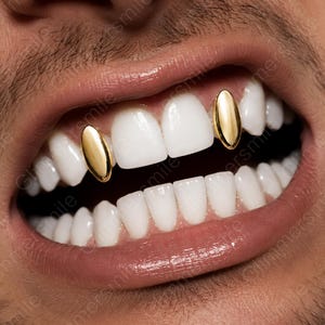 May include: A pair of polished gold tooth caps, known as grills, fitted over the upper lateral incisors. The smooth, metallic gold covers are shaped to fit the teeth, creating a reflective surface that contrasts with the natural white teeth.