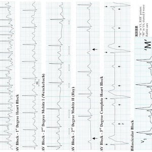 May include: A medical reference card titled Cardiology EKG displaying various heart rhythm tracings including Atrial Flutter, Atrial Fibrillation, AV Blocks, and Bifascicular Block. The chart features black waveforms on a blue grid with text labels.