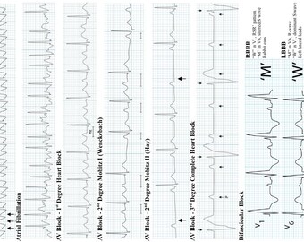 ACLS Algorithms EKG Interpretation Cards for Exam Prep, Clinical Use