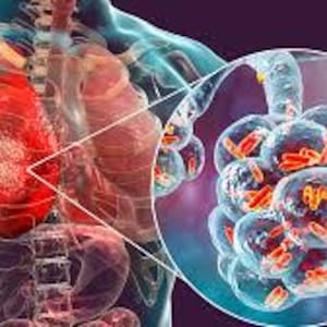 Può includere: Illustrazione anatomica del sistema respiratorio umano, evidenziando i polmoni e gli alveoli. Il polmone sinistro è rosso, indicando infiammazione, con una vista dettagliata degli alveoli che mostrano batteri. Sfondo viola scuro.