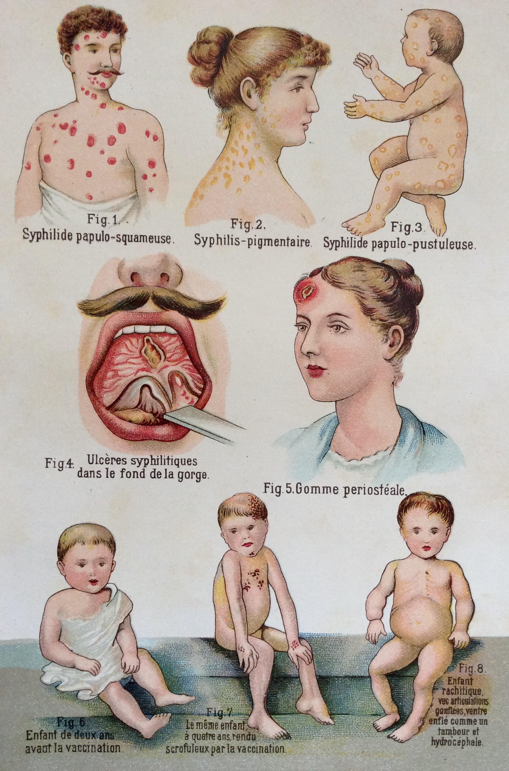 Antique Print French Bookplate 1900s SYPHILIS Chromolithograph - Etsy  Finland