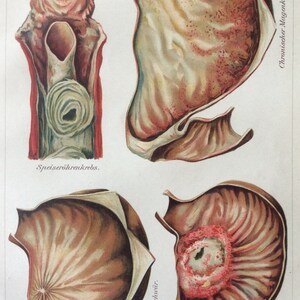 Vintage 1907 German STOMACH CANCER Medical Chromolithograph Anatomy Diagram Bookplate Dissection