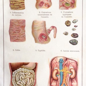 Impresión antigua francés Anatomía Bookplate 1900s INTESTINOS DISECCIÓN Venas Órganos de la enfermedad ANATOMÍA Cromolítico Diagrama médico vintage 190