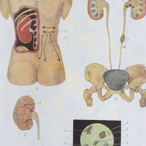 Antique French Anatomy Bookplate Print 1900s KIDNEY DISEASE 1902 Vintage Medical Diagram