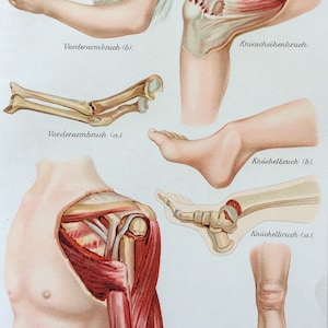 Antique Print 1907 German MUSCLE BONE FRACTURE Medical Chromolithograph Anatomy Diagram Bookplate Dissection
