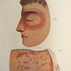 Vintage 1920s bookplate médico impresión diagnóstico diagrama enfermedad facial Erisipela gafas material de collage