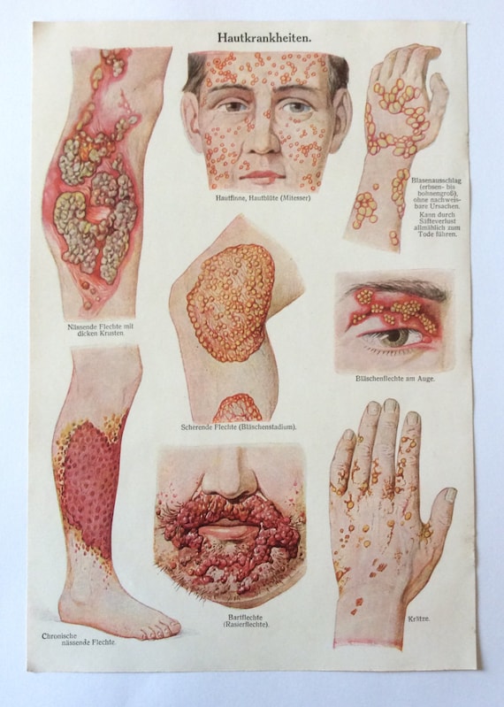 Skin Diseases Common in Older Adults. Skin disease has been recorded for thousands of years. Ancient Egyptian papyri described itchy rashes and fungal infections. Greek physicians like Hippocrates identified scaling diseases similar to psoriasis.