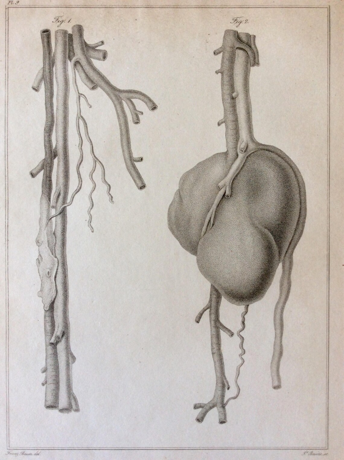 Antique 1828 ANATOMY ENGRAVING TUMOUR Popliteal Aneurism Artery ...