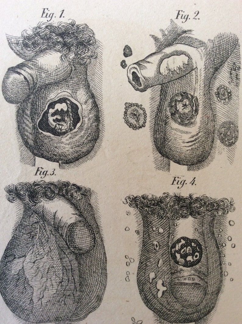 Ancienne gravure anatomie pénis testicules maladie Scrotum Etsy