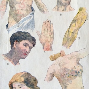 Antique Print French Anatomy Bookplate Print 1910 DISEASE Skin Medical Diagram