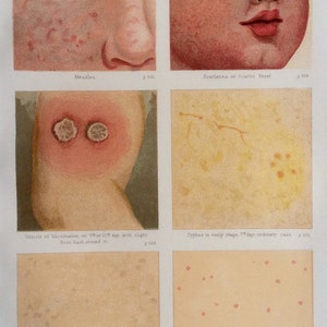 Antique Print Anatomy Bookplate Chromolithograph Rash Spots Measles Pox Disease Virus Scabrous Pustule 1908 Vintage Medical Diagram