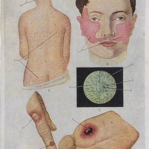 Antique Print French Anatomy Bookplate 1900s SKIN INFECTIONS 1902  Vintage Medical Diagram