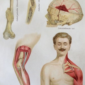 Antique Print 1907 German MUSCLE BONE FRACTURE Medical Chromolithograph Anatomy Diagram Bookplate Dissection