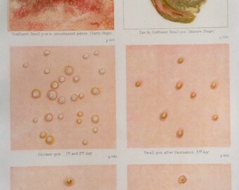 Impresión antigua Anatomía Placa de archivo Cromolítico Pequeña Enfermedad de la Viruela Virus del Oído Molde Escabroso Pustule Zombie 1908 Diagrama médico vintage