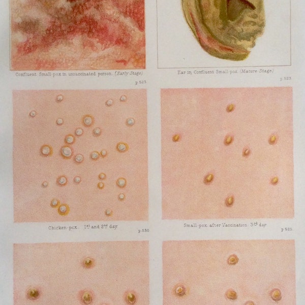 Impresión antigua Anatomía Placa de archivo Cromolítico Pequeña Enfermedad de la Viruela Virus del Oído Molde Escabroso Pustule Zombie 1908 Diagrama médico vintage