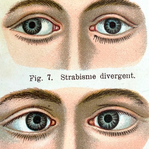 Antique BOSS-EYED Print French Anatomy Bookplate Circa 1900 Chromolithograph EYE Ocular Medical Diagram Vision Eye Doctor
