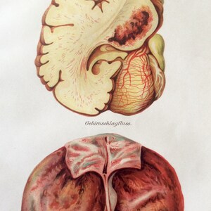 Vintage 1907 German BRAIN DISEASE Encephilitis Medical Chromolithograph Anatomy Diagram Bookplate Dissection