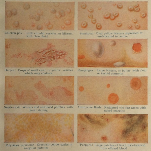 Vintage 1920s Medical Bookplate Print Diagnostic Skin Condition Diagram Disease Pustules Spot Boils Collage Material