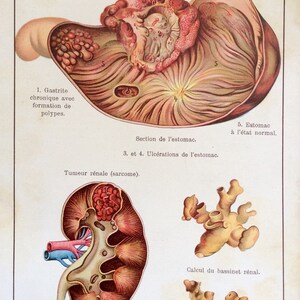 Impresión antigua francés anatomía cromoliponografía Bookplate 1909 ENFERMEDAD RENAL ESTOMACAL Disección órganos diagrama médico vintage