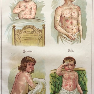 Impresión antigua francés bookplate impresión MALADIES des enfants niños enfermedad de la piel Cromolítico Victoriano Vintage Diagrama médico 1900