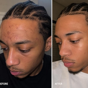 Può includere: Un confronto a schermo diviso che mostra un viso prima e dopo un trattamento per la pelle. Il lato sinistro mostra acne sulla fronte, mentre il lato destro mostra un incarnato più chiaro con una texture della pelle più liscia e una riduzione.