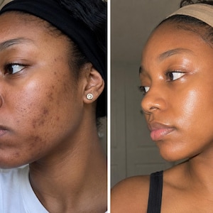May include: A side-by-side comparison of a face showing skin texture changes. The left side displays dark spots and uneven pigmentation, while the right side shows a smoother, more uniform complexion with a natural glow and clear skin tone.