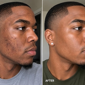May include: A split-screen comparison showing a profile view of a person with dark skin. The left side labeled BEFORE shows skin with visible dark spots and texture. The right side labeled AFTER shows the same person with a smoother, clearer complexion.