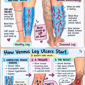 May include: An educational medical infographic titled Venous Disease and How Venous Leg Ulcers Start. It features diagrams of healthy and diseased legs, explaining blood flow, venous insufficiency, and the progression from trauma to ulceration.