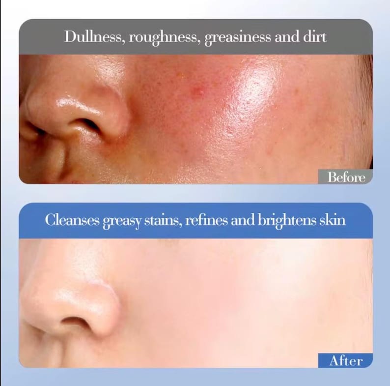 May include: A split-screen image shows a before-and-after comparison of skin. The top section, labeled "Before," displays skin with dullness, roughness, and greasiness. The bottom section, labeled "After," shows skin that is cleansed, refined, and brightened.